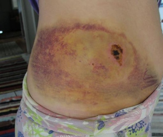  Com graves queimaduras no corpo, trabalhadora não consegue afastamento